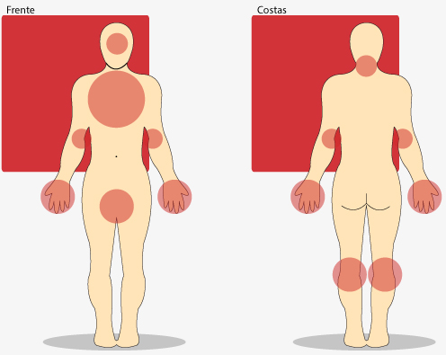Áreas mais comuns do aparecimento de eczemas em adultos